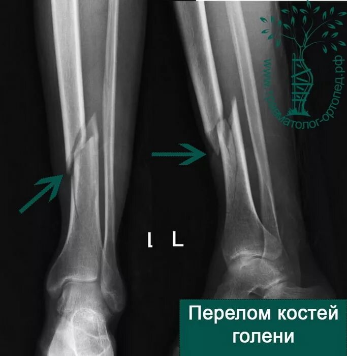 Трещина голени. Перелом голени и малоберцовой кости. Берцовая кость перелом. Перелом 2 берцовых костей.