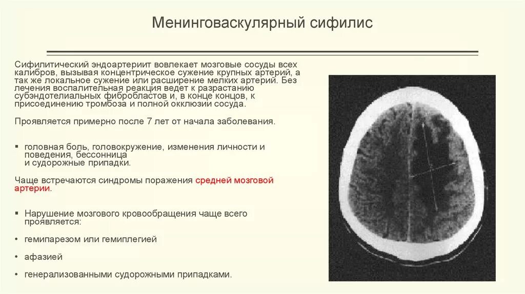 Причины сужения головного мозга. Сифилитическая Гумма головного мозга. Сифилитическая Гумма в головном мозге мрт. Сифилис поражение головного мозга.