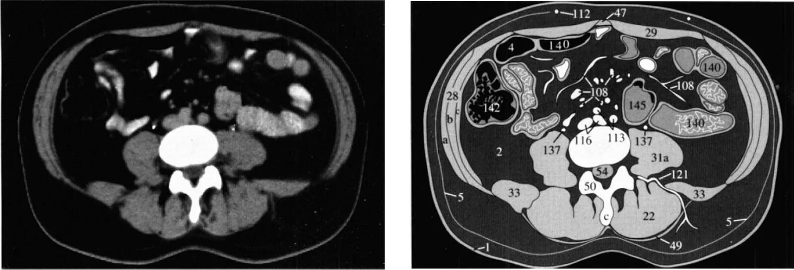 Срезы кт. Кт легких. Кт грудной клетки здорового человека. Срезы кт. Кт нормальной грудной клетки.