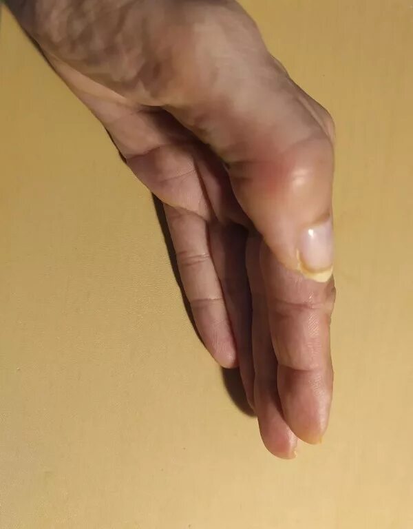 Суставы пальцев сильно. Сустав большого пальца руки. Крупные суставы пальцев. Артрит большого пальца руки.