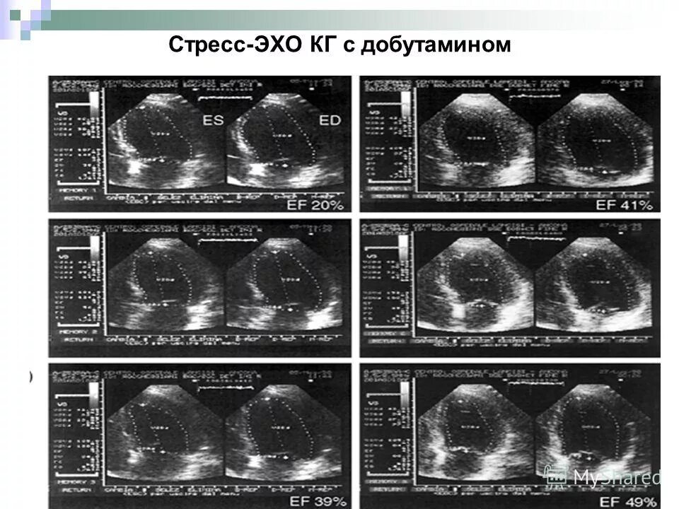 Стресс с добутамином