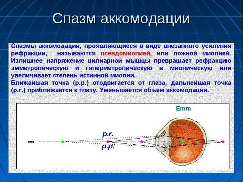 Слабая миопия глаза что. Мышцы аккомодации глаза. Нарушение аккомодации ложная близорукость. Спазм аккомодации ложная близорукость. Рефракция глаза при спазме аккомодации при исходной эмметропии.