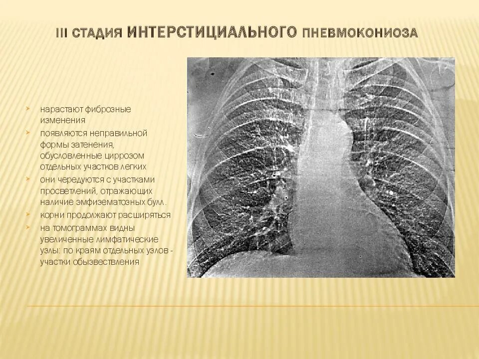 Iii стадия. Узелковая форма пневмокониоза. пневмокониоз 1 стадия рентген. пневмокониоз легких 1 стадия рентген. узелковый пневмокониоз рентген.