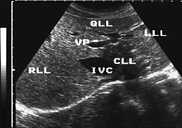 Протоковые изменения в печени. КВР печени УЗИ. Сегменты печени на УЗИ. Сегменты печени на УЗИ схема. Доли печени на УЗИ.