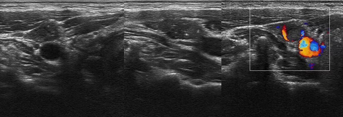 Гипоэхогенное образование лимфоузла. Метастазы в лимфоузлы на УЗИ. Гипоэхогенное образование УЗИ. Лимфатический узел щитовидной железы УЗИ. Щитовидная железа узи лимфоузлы