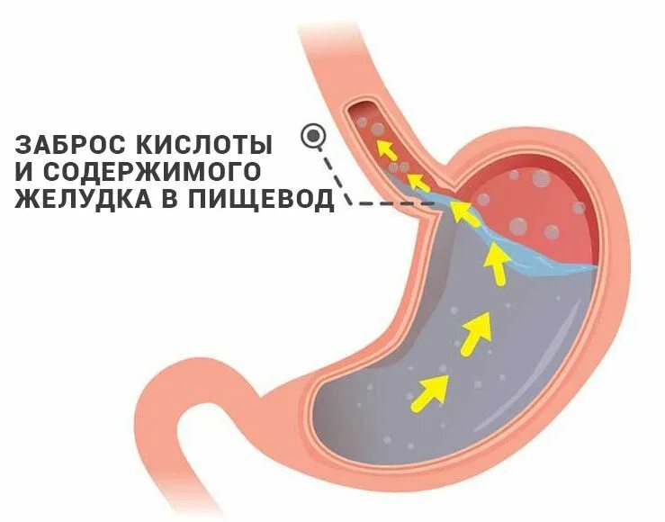 Сильный рефлюкс