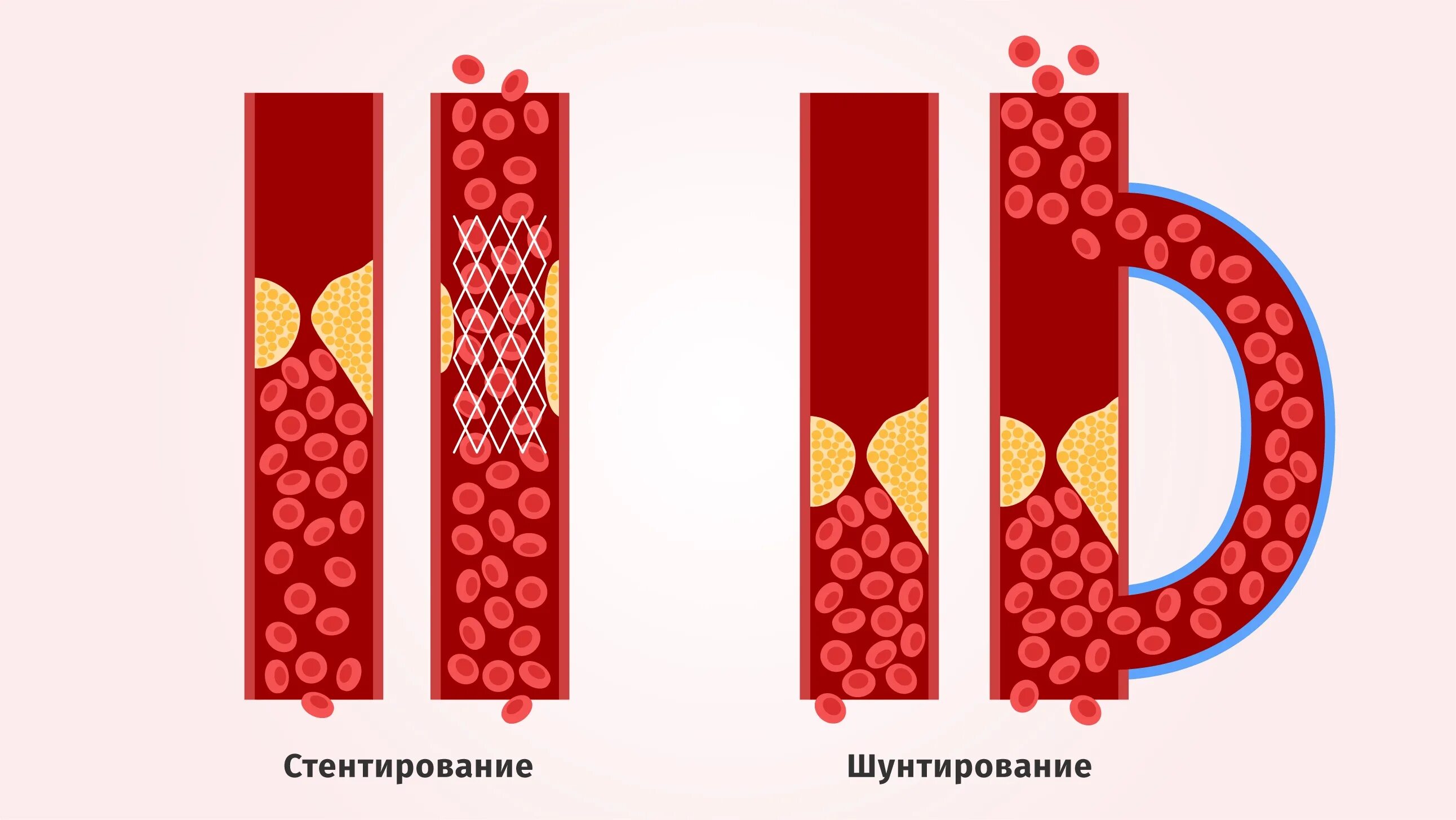 Шунтирование и стентирование. Шунтирование сердца и стентирование в чем разница. Шунтирование сосудов сердца стент. Шунтирование и стентирование сосудов сердца в чем разница. Стентирование прогнозы