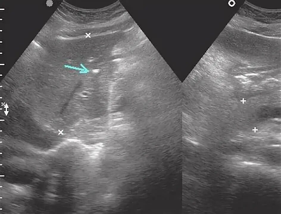 Микрокальцинаты в почках на УЗИ. Кальцинат в селезенке на УЗИ. Микрокальцинаты в печени на УЗИ. Кальцинат правой доли печени