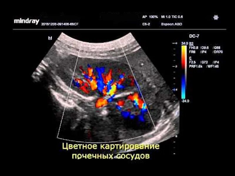 Узи сердца узи почек. Допплеровское сканирование сосудов почек. узи сосудов почки допплер. междолевая артерия почки на узи. кровоток в почках исследование.