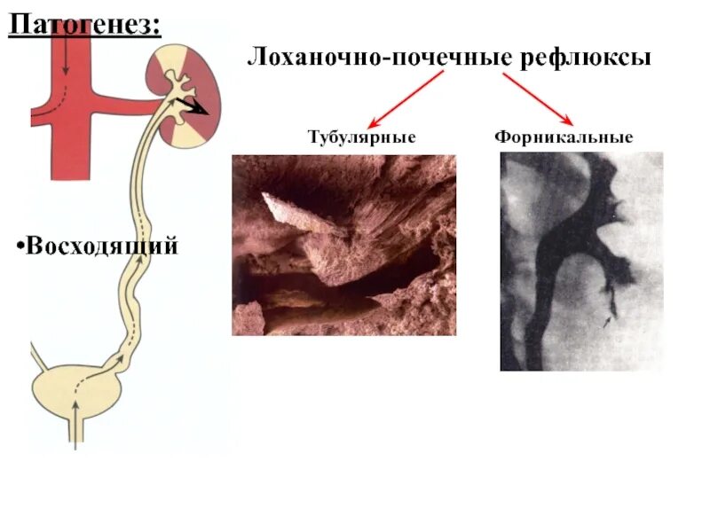 Рефлюкс мочи. Лоханочно почечный рефлюкс это. Внутрипочечный рефлюкс. Лоханочно-почечные рефлюксы Тубулярные.