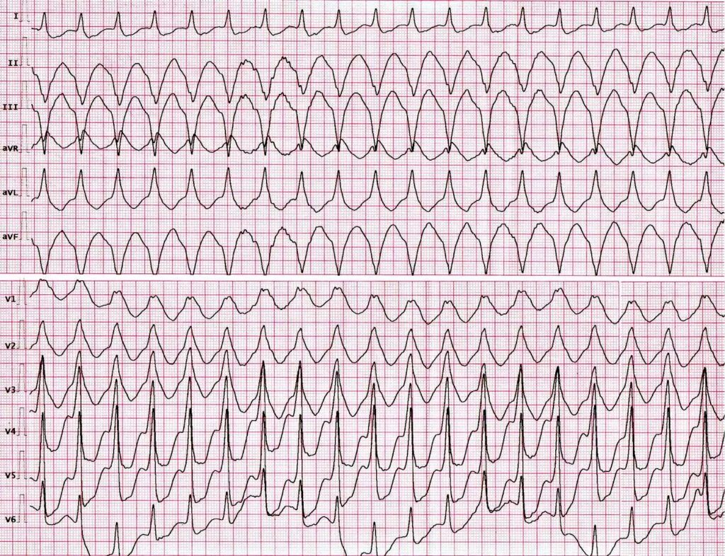 Желудочковая тахикардия на экг. Пароксизмальная желудочковая тахикардия на ЭКГ. ЭКГ при желудочковой тахикардии. Пароксизмальная тахикардия желудочков ЭКГ.
