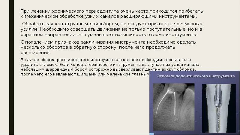 Осложнения периодонтита. Ошибки и осложнения при периодонтите. Осложнения при пломбировании корневых каналов. Ошибки и осложнения при лечении периодонтита. Осложнения эндодонтического лечения