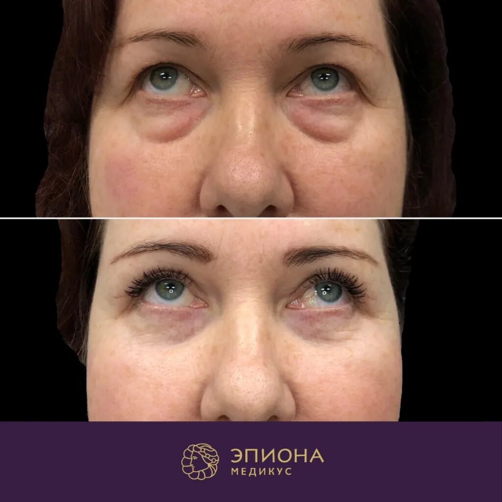 круговая блефаропластика. лазерная блефаропластика век нижневартовск. пластика век блефаропластика отзывы. операция блефаропластика нижних век. блефаропластика верхних век 2021.