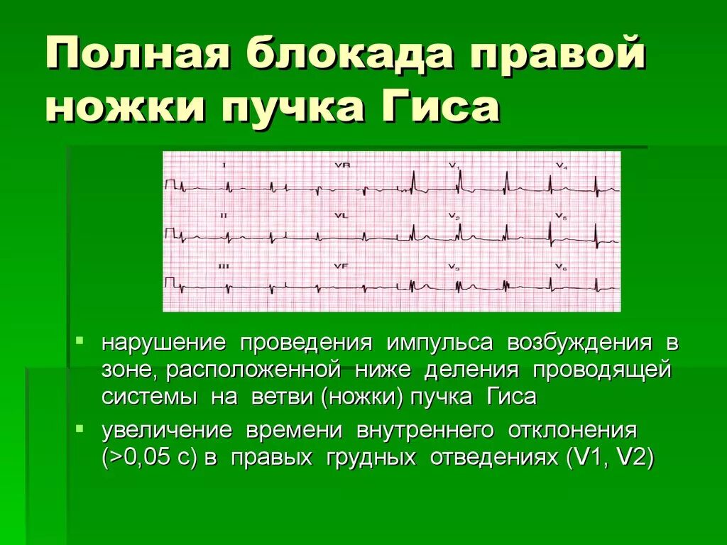 Чем опасна блокада правой ножки гиса. Полная и неполная блокада правой ножки пучка Гиса отличия. Критерии блокады правой ножки пучка Гиса. Блокада правой ножки пучка Гиса на ЭКГ. Критерии полной блокады правой ножки пучка Гиса.