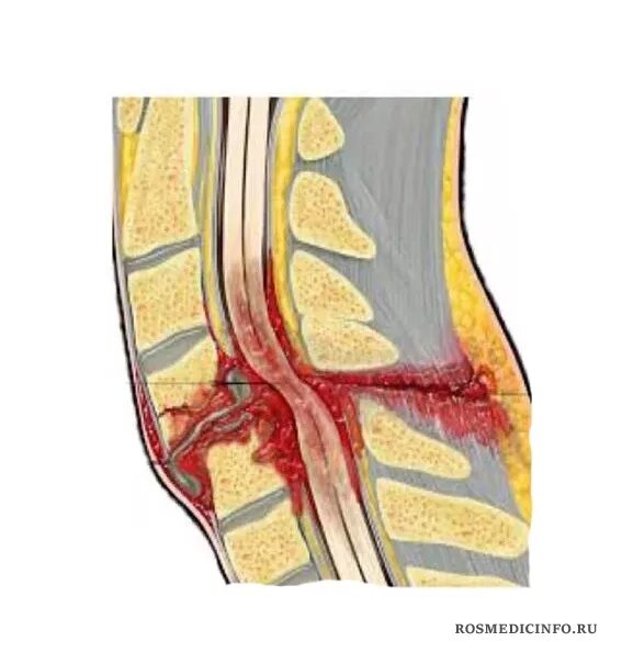 Сдавление спинного. Воспаление Корешков спинного мозга. Травматическая миелопатия спинного мозга. Ушиб и сдавление спинного мозга. Гематомиелия спинного.