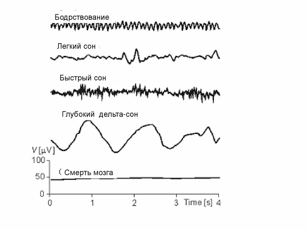 Легкие изменения ээг. ЭЭГ бодрствования лёгкий сон и глубокий сон. Глубокий легкий и быстрый сон. Электроэнцефалография сна. Легкий и глубокий сон энцефалограмма.