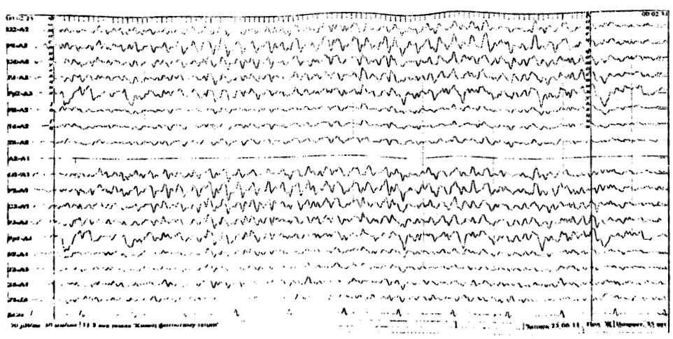 Дезорганизованный тип ээг. Региональная эпилептиформная активность ЭЭГ. Эпилептиформная активность низкого индекса на ЭЭГ. Генерализованная эпилептиформная активность на ЭЭГ У ребенка. Эпилептиформная активность на ЭЭГ назначения невролога.
