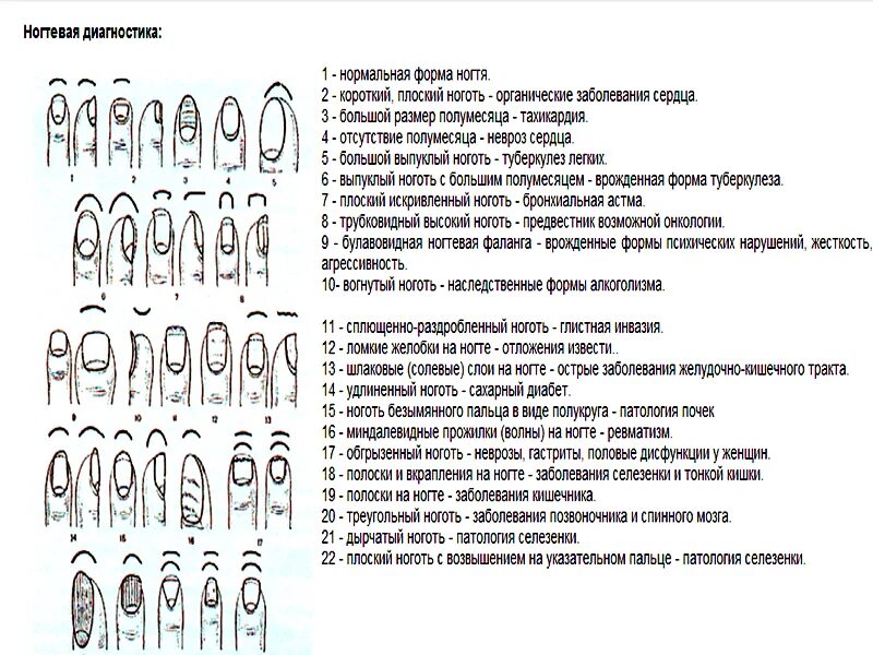 О чем говорит форма ногтей. Болезни по ногтям пальцев рук таблица. Диагностика заболеваний по ногтям на руках. Определение диагноза по ногтевой пластине. Диагноз болезни по ногтям.