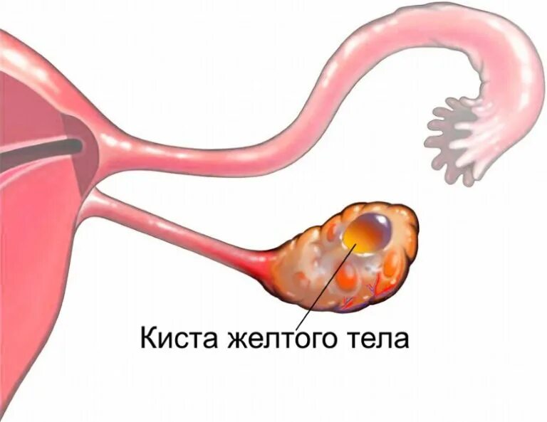 Киста желтого тела яичников. Функциональная киста яичника или желтое тело. Киста желтого тела левого яичника. Регресс кисты желтого тела.