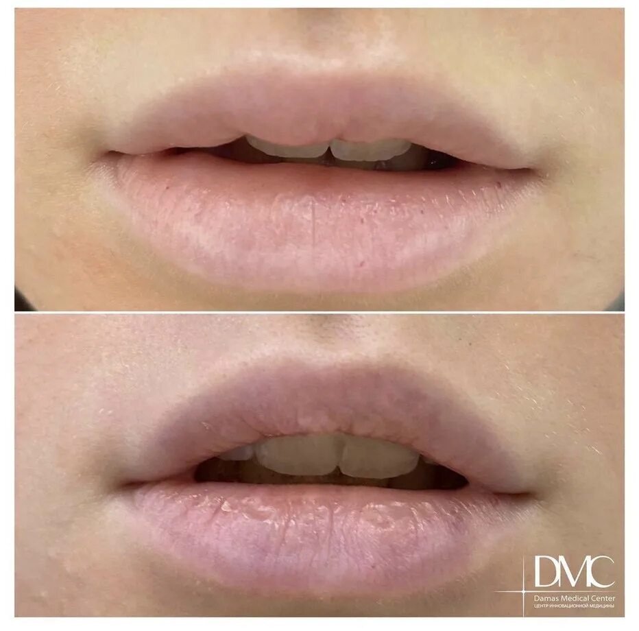 Препараты для увеличения губ. После удаления филлера лонгидазой. После удаления филлера лонгидазой. После удаления филлера лонгидазой. Удаление филлера с губ лонгидазой.
