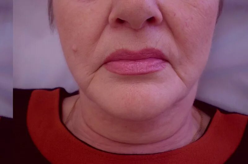 Морщины скорби. Мимические морщины вокруг рта. Филлеры в уголки морщины марионетки. Морщины скорби. Ботокс от морщин марионеток.