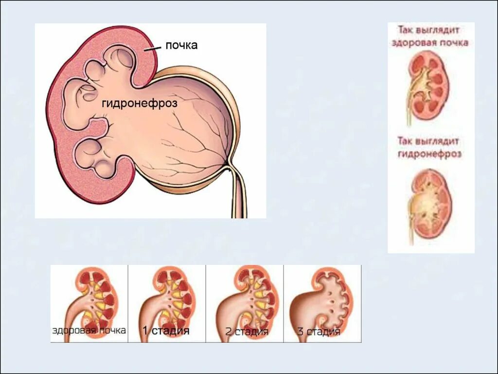 Заболевание почек гидронефроз. Гидронефроз почки 3 степени. Гидронефроз почки 3 стадии. Гидронефроз почки УЗИ степень. Гидронефроз почек клинические рекомендации.