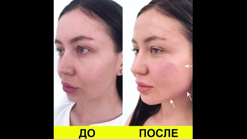 Увеличение скул филлерами, имплантами. Цена, отзывы, фото до и после