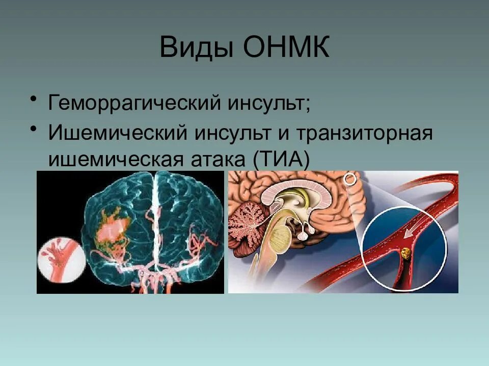 ОНМК. Инсульт острое нарушение мозгового кровообращения. Осложнения ОНМК по геморрагическому типу. ОНМК ишемический инсульт.