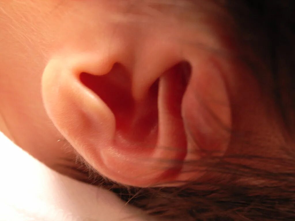 Ухо ребенка. Отомикоз ушной раковины. Деформированные ушные раковины.