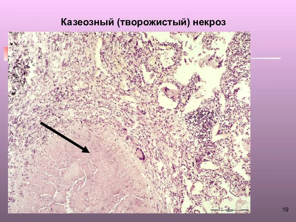 Коагуляционный некроз гистология. Казеозная пневмония патанатомия микропрепарат. Казеозный некроз микропрепарат патанатомия. Казеозная пневмония микропрепарат. Распад селезенки