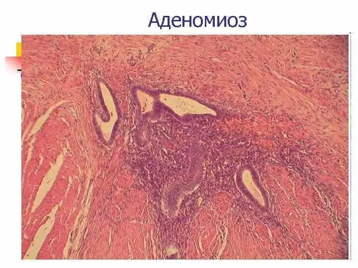 Степени диффузной формы аденомиоза. Степени диффузной формы аденомиоза
