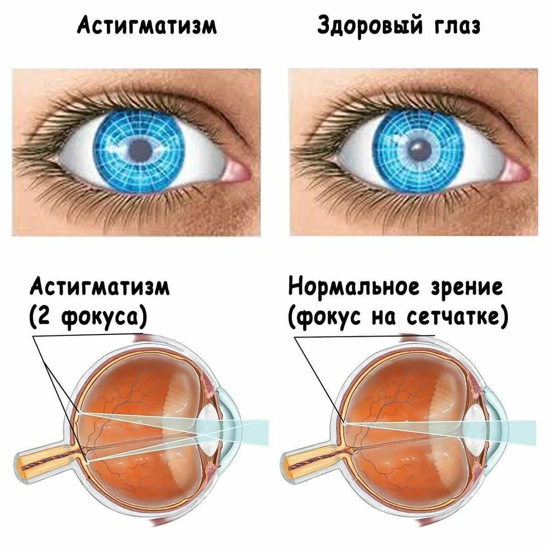 Как изменяется хрусталик