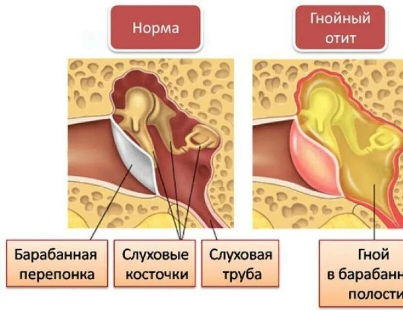 Тубоотит отзывы