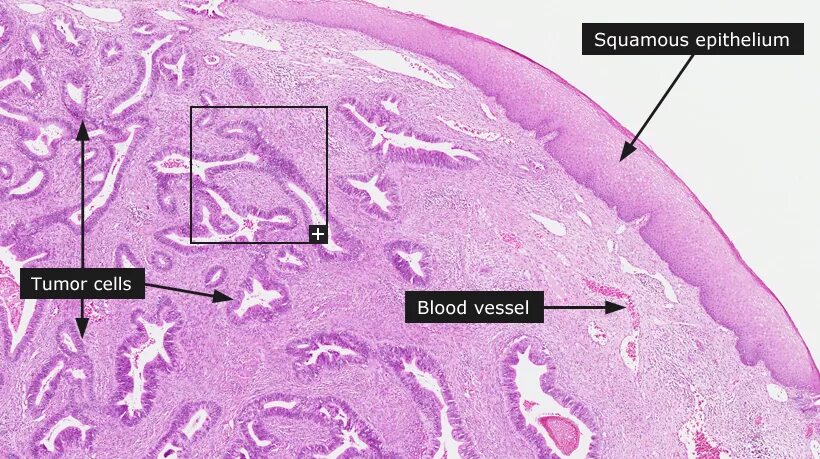 Рак матки препарат. Эндоцервикоз шейки матки микропрепарат. Шейка матки гистология строение. Анатомия и гистология шейки матки. Карцинома шейки матки гистология.