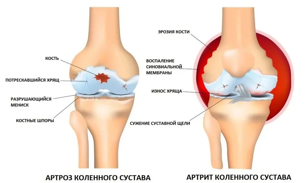 Артрит и артроз разница. Артрит и артроз коленного сустава. Артрит или артроз коленного сустава отличия. Остеоартроз и артрит разница. Ревматоидный артрит и артроз.