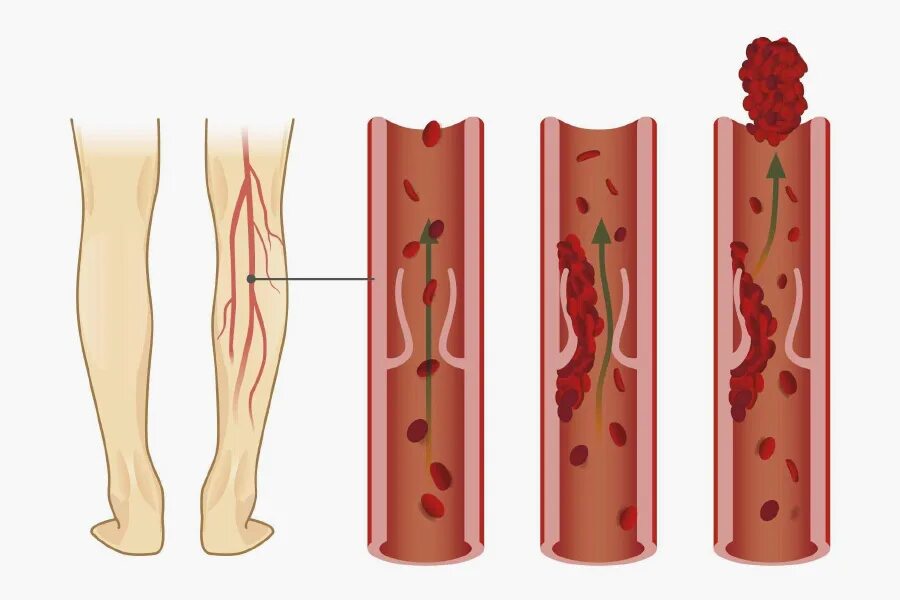 Чем отличается тромбоз. Тромбофлебит и флеботромбоз. Флеботромбоз подострый. Флеботромбоз глубоких вен. Флеботромбоз глубоких вен нижних конечностей симптомы.