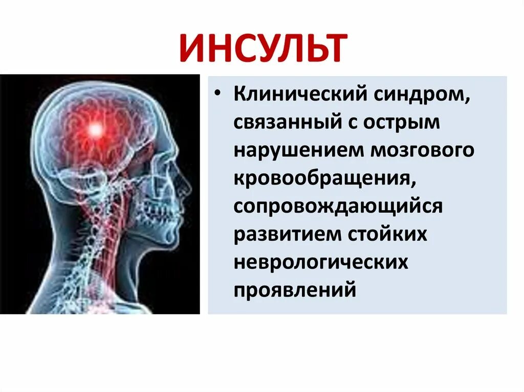 Инсульт. Презентация на тему инсульт. Клинический инсульт.