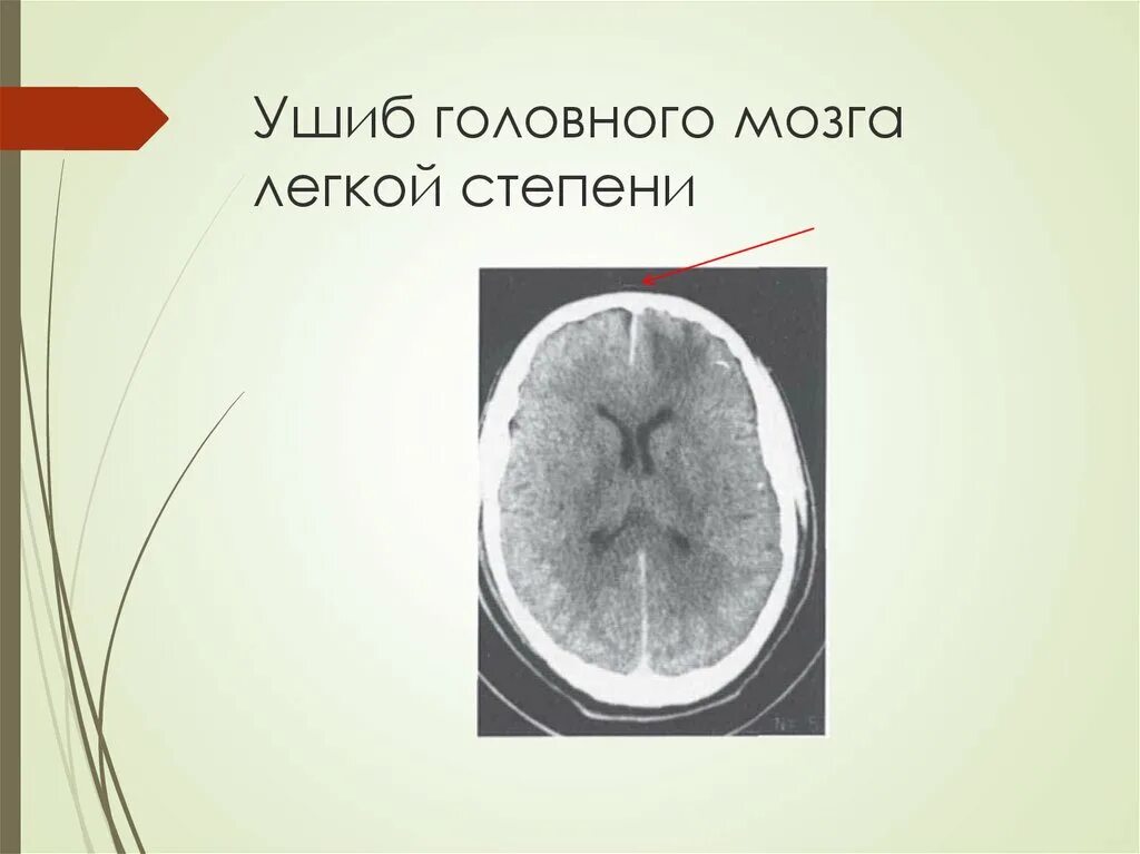 Травма мозга очаговая. Ушиб головного мозга степени. Ушиб мозга легкой степени. Ушиб головного мозга головного мозга.