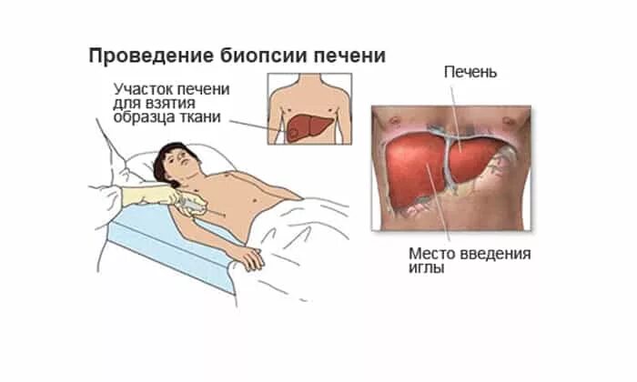 Биопсия печени после биопсии. Чрескожная пункционная биопсия печени. Биопсия печени при циррозе. Пункционная биопсия при гепатите.