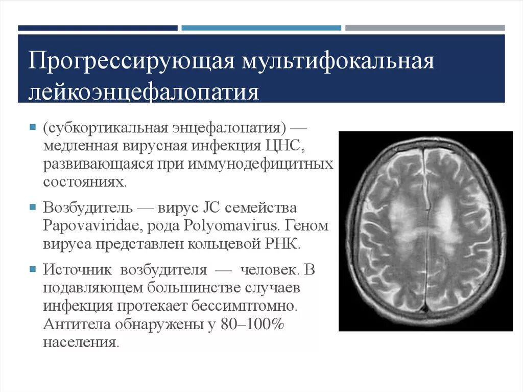 Прогрессирующая мультифокальная лейкоэнцефалопатия кт. Прогрессирующая мультифокальная лейкоэнцефалопатия (ПМЛ). Прогрессирующая мультифокальная лейкоэнцефалопатия гистология. Лейкоэнцефалопатия головного мозга мрт. Многоочаговое поражение головного мозга