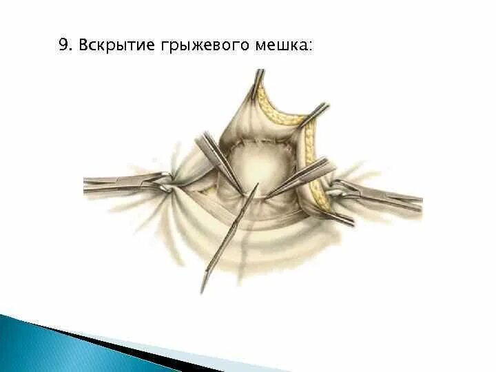 Вскрытие грыжевого мешка. Круглая маточная связка. Сальник в грыжевом мешке. Где находятся круглые связки