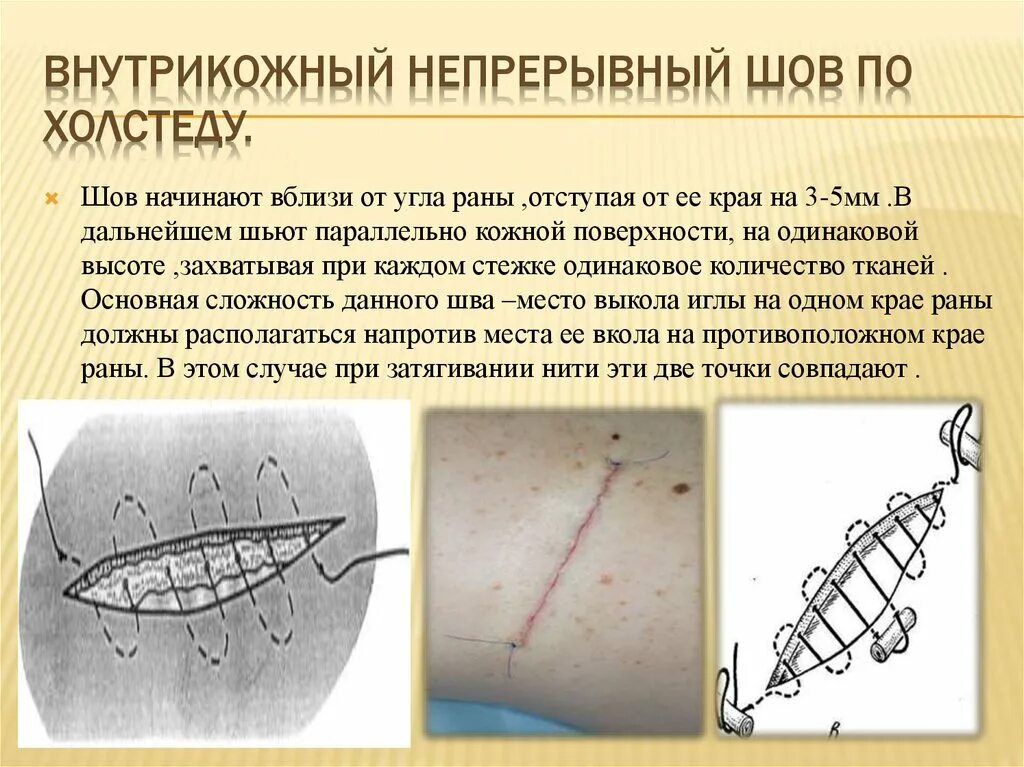 Температура после шва. Непрерывный внутрикожный косметический шов. Шов операционный внутрикожный. Косметический шов Холстеда. Непрерывный внутрикожный шов Холстеда.