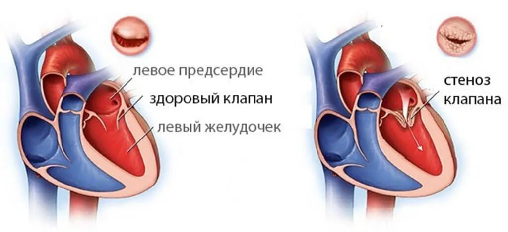 Митральные пороки сердца (стеноз, недостаточность. Створки митрального клапана анатомия. Клиника стеноза и недостаточности митрального клапана. Стеноз митрального клапана гемодинамика.