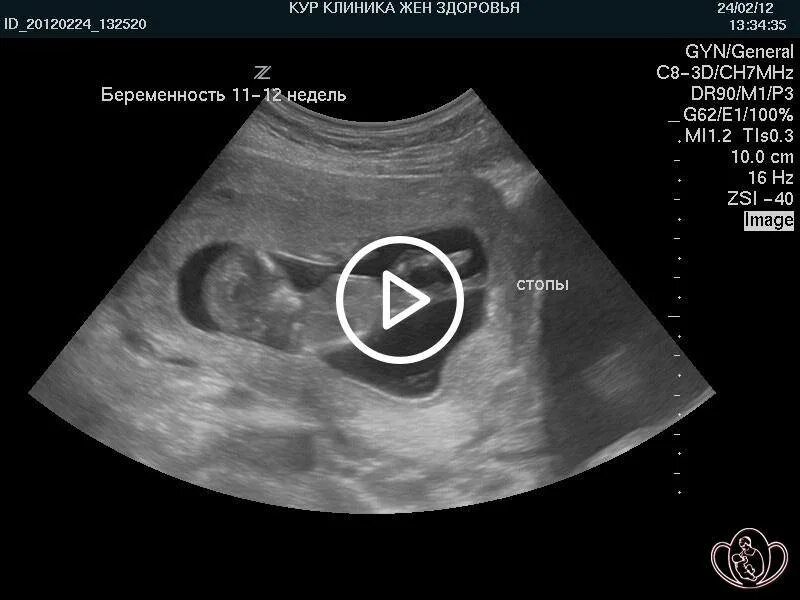Что происходит на 12 неделе. Как выглядит плод в 12 недель на УЗИ. 12 Недель беременности размер плода. Как выглядит ребенок на УЗИ В 12 недель. Плод на 11-12 неделе беременности.