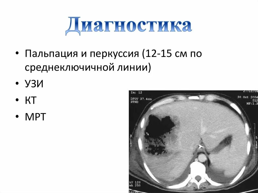 Гепатоза гепатомегалии