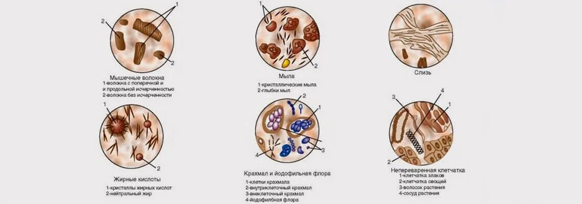 Микроскопия кала соединительная ткань. Исследование кала копрограмма. Копрограмма микроскопическое исследование расшифровка. Соединительная ткань кал копрограмма. Грибы в копрограмме у взрослого