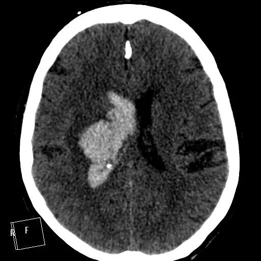 Кровоизлияние ствола мозга. Субарахноидальное кровоизлияние кт. Субарахноидальное кровоизлияние головного мозга на кт. Субарахноидальное кровоизлияние на кт ГМ. Субарахноидальное кровоизлияние кт картина.