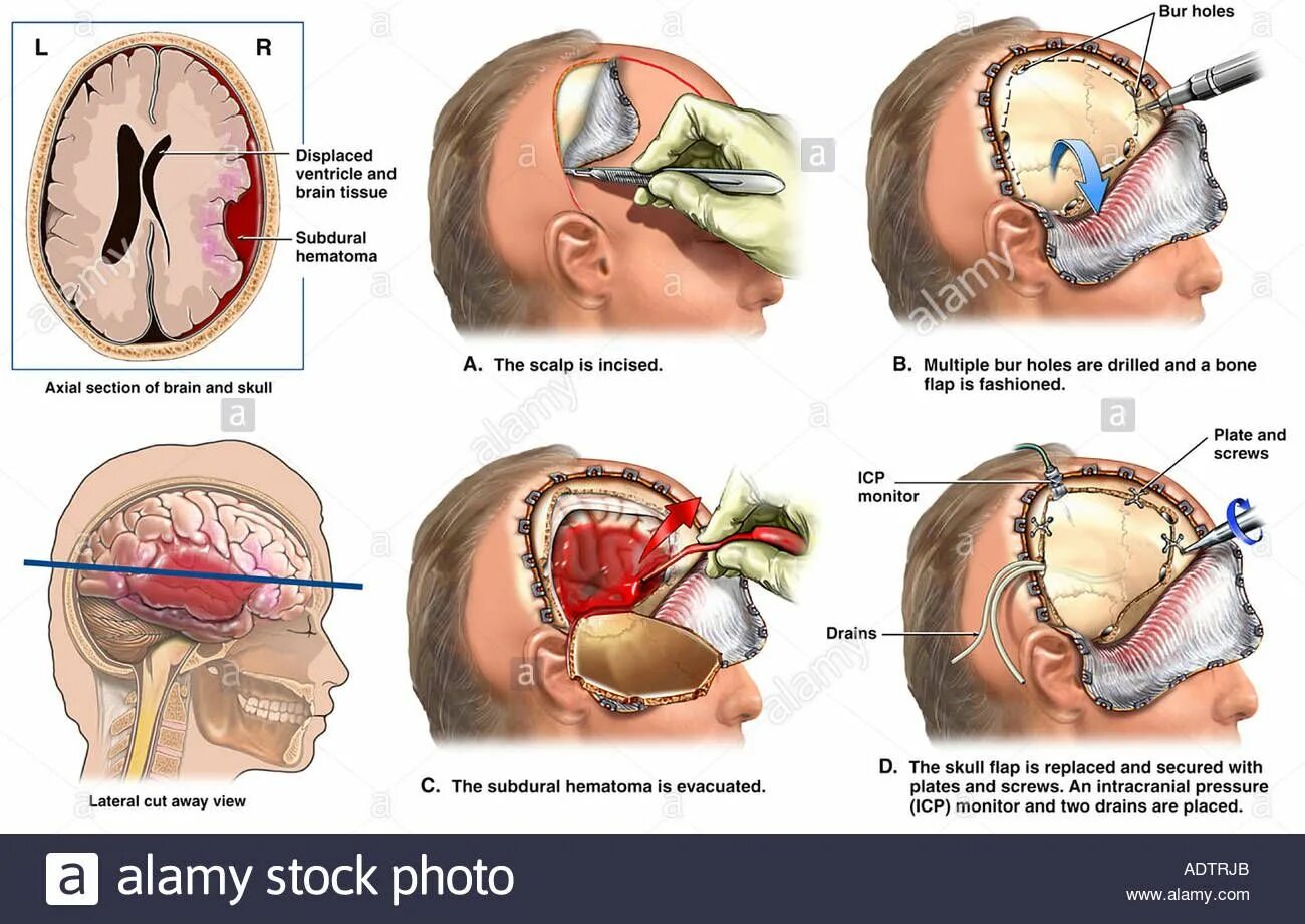 Scalp перевод. Субдуральная гематома Трепанация. Трепанация черепа при инсульте. Трепанация черепа гематома. Трепанация черепа при опухоли.