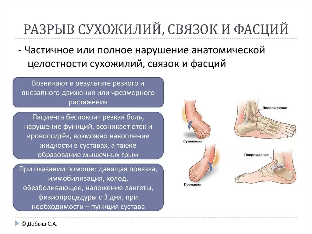 Почему территориальный разрыв. Характеристика разрыва связок и мышц. Характерный признак разрыва связок и мышц. Симптомы повреждения сухожилий.