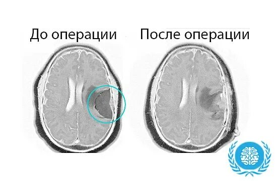 Менингиома головного мозга. После операции менингиомы головного мозга